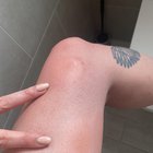 Please help, abroad and a friend of a friend thinks I have Lyme Disease and I’m panicking